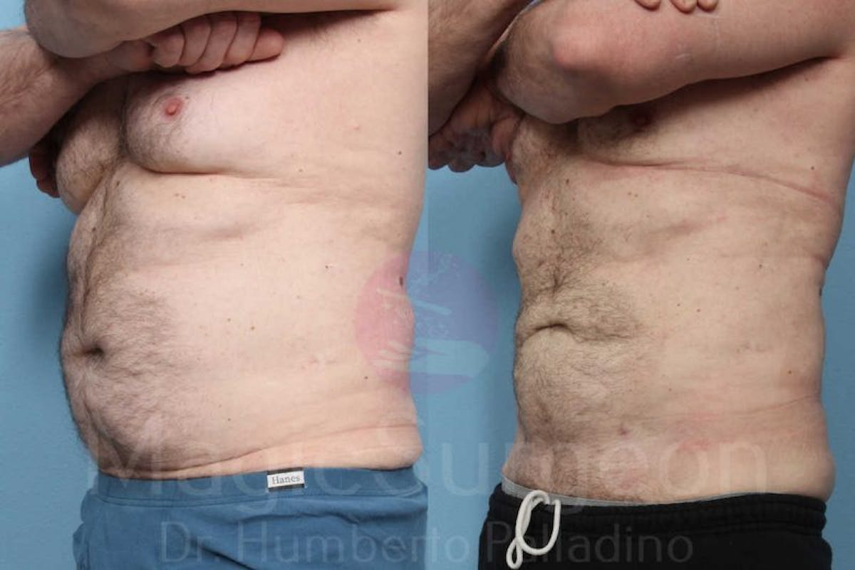 Liposuction Before & After Gallery - Patient 133182322 - Image 2