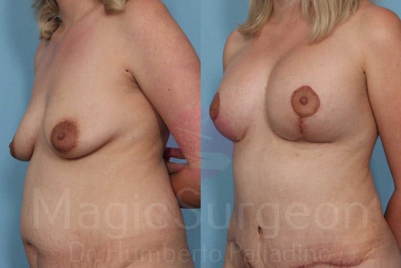 Mommy Makeover Before & After Gallery - Patient 133182325 - Image 2
