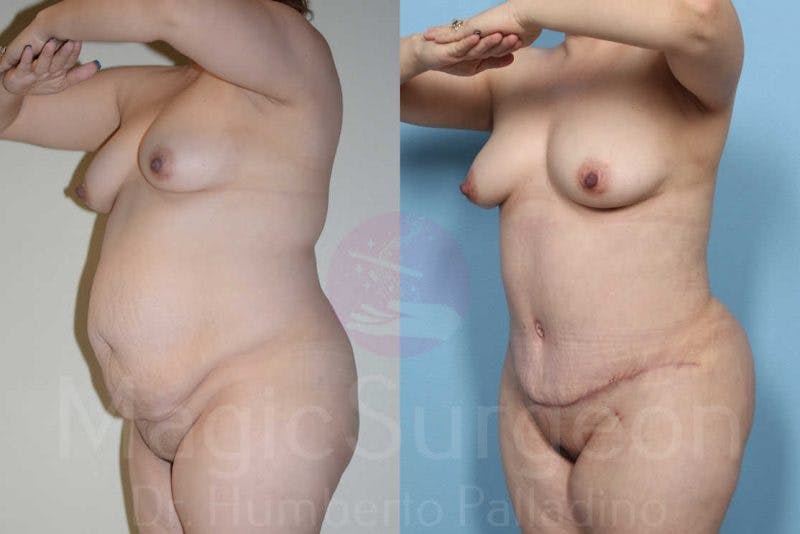Tummy Tuck Before & After Gallery - Patient 133182323 - Image 2