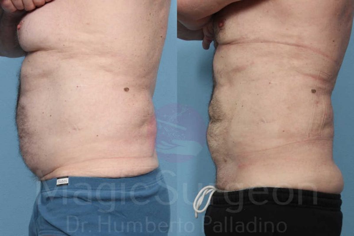 Liposuction Before & After Gallery - Patient 133182322 - Image 3