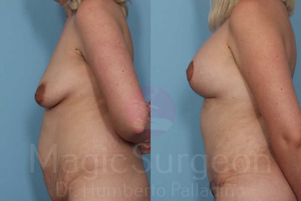 Mommy Makeover Before & After Gallery - Patient 133182325 - Image 3