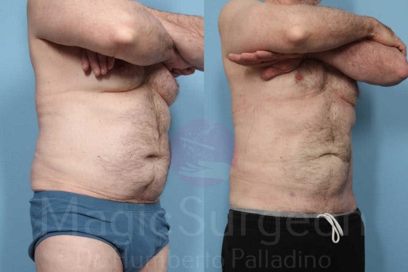 Liposuction Before & After Gallery - Patient 133182322 - Image 4
