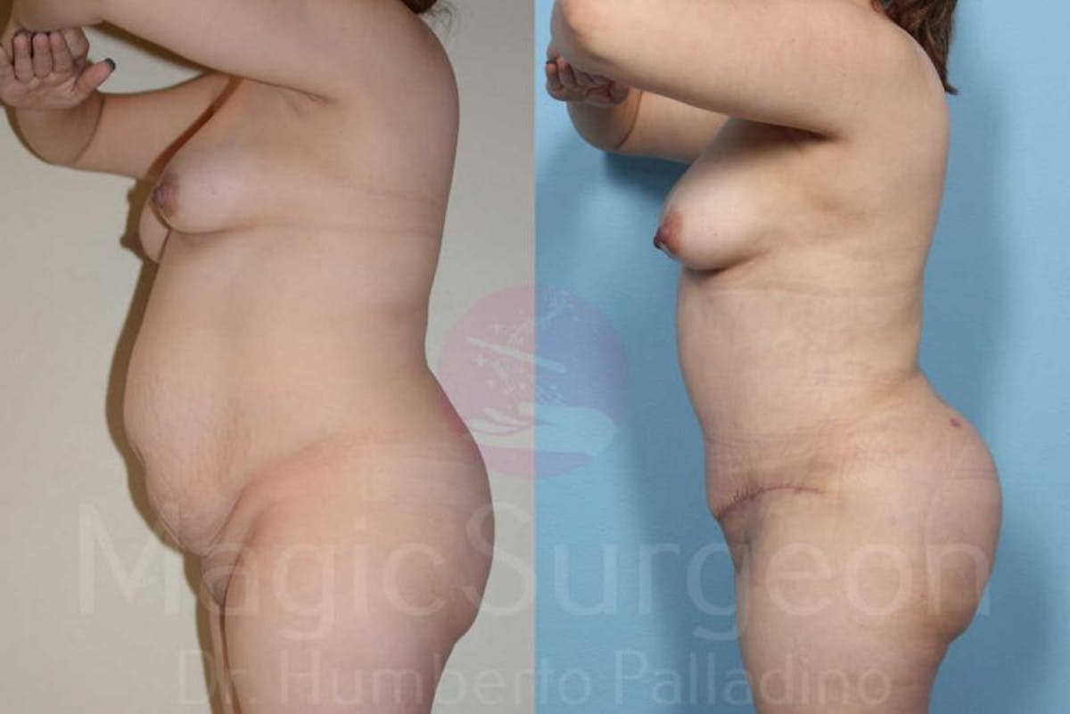 Tummy Tuck Before & After Gallery - Patient 133182323 - Image 3