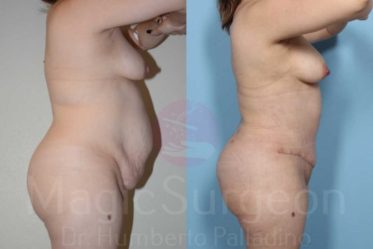 Tummy Tuck Before & After Gallery - Patient 133182323 - Image 5