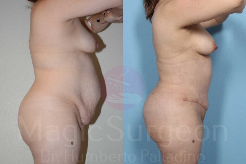 Tummy Tuck Before & After Gallery - Patient 133182323 - Image 4
