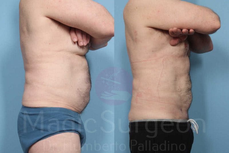 Liposuction Before & After Gallery - Patient 133182322 - Image 5