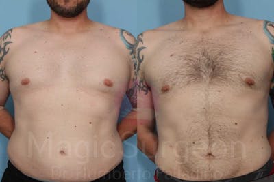 Liposuction Before & After Gallery - Patient 133182328 - Image 1