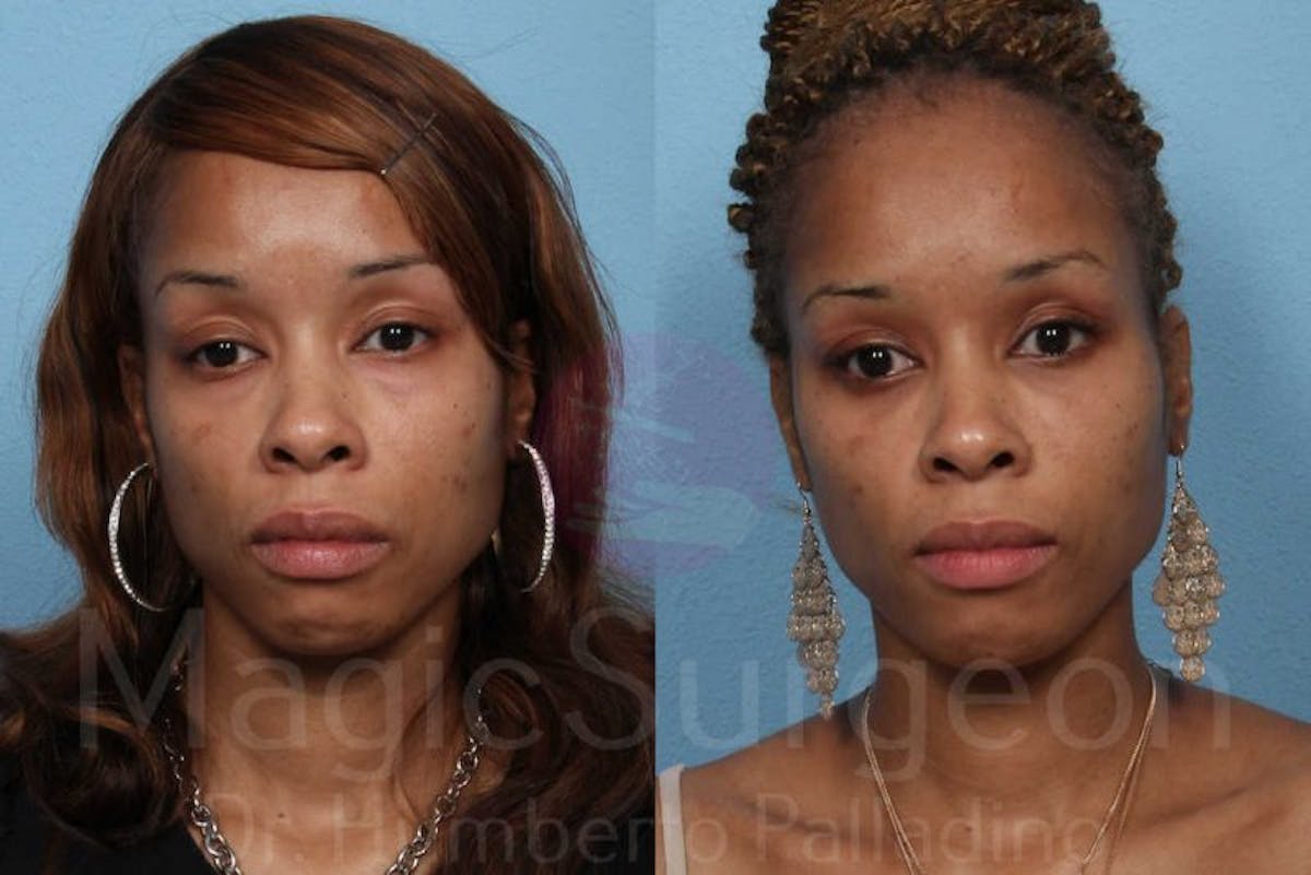 Blepharoplasty Before & After Gallery - Patient 133182326 - Image 1