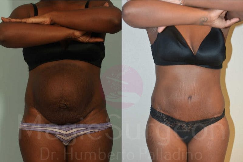 Tummy Tuck Before & After Gallery - Patient 133182327 - Image 1