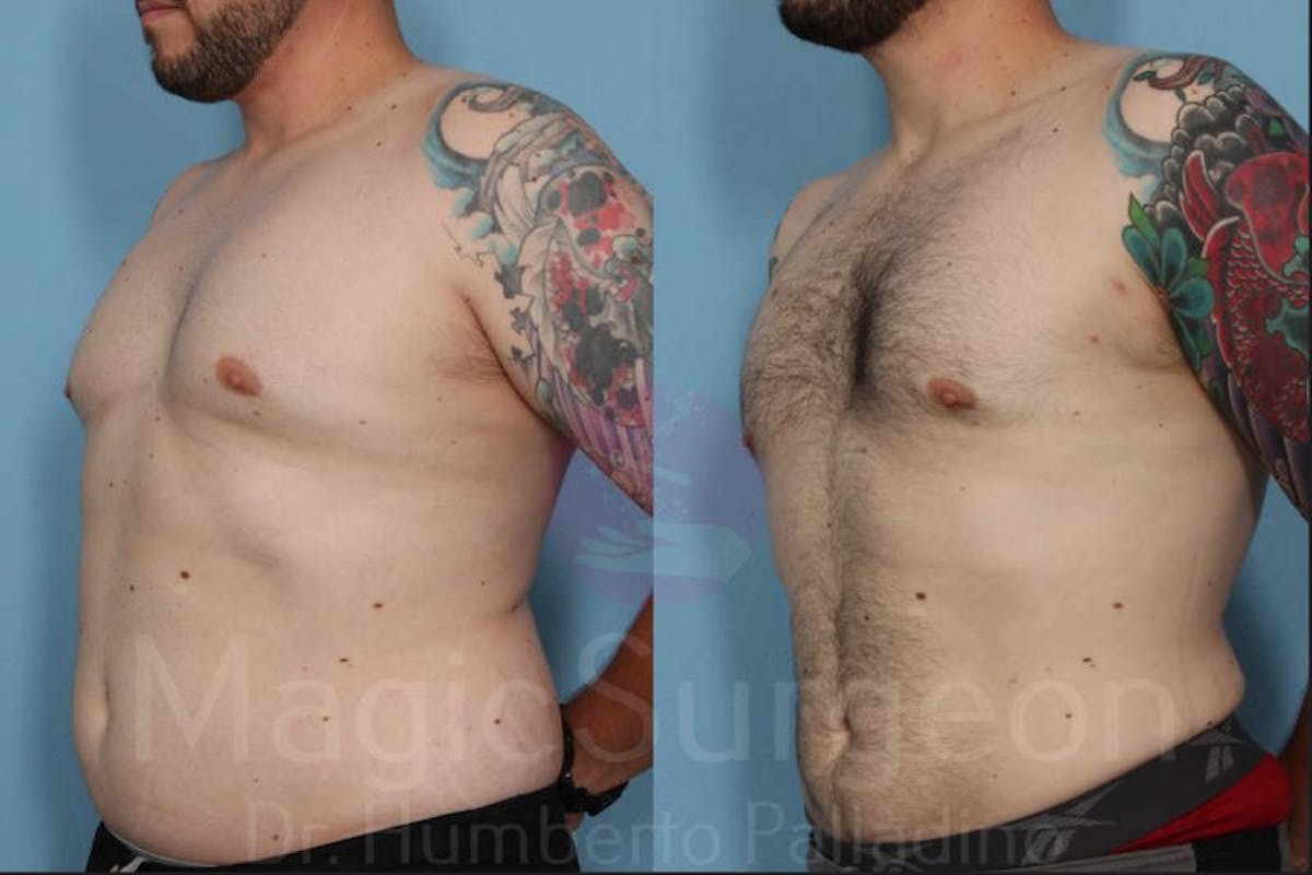 Liposuction Before & After Gallery - Patient 133182328 - Image 2