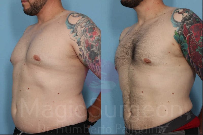 Liposuction Before & After Gallery - Patient 133182328 - Image 2