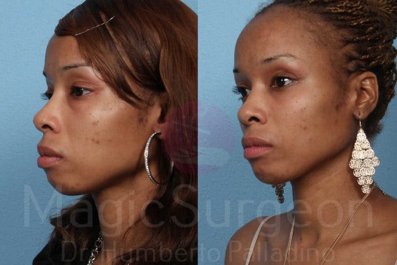 Blepharoplasty Before & After Gallery - Patient 133182326 - Image 2