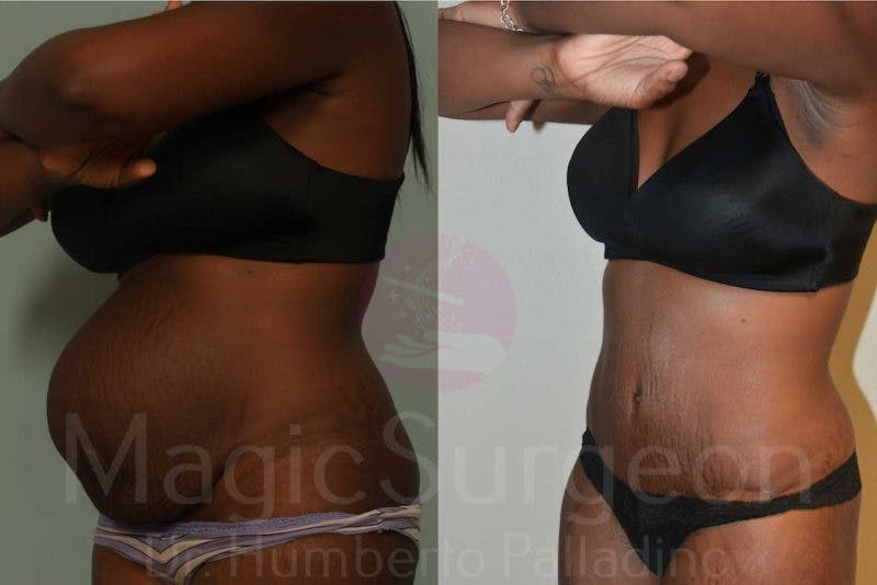 Tummy Tuck Before & After Gallery - Patient 133182327 - Image 2