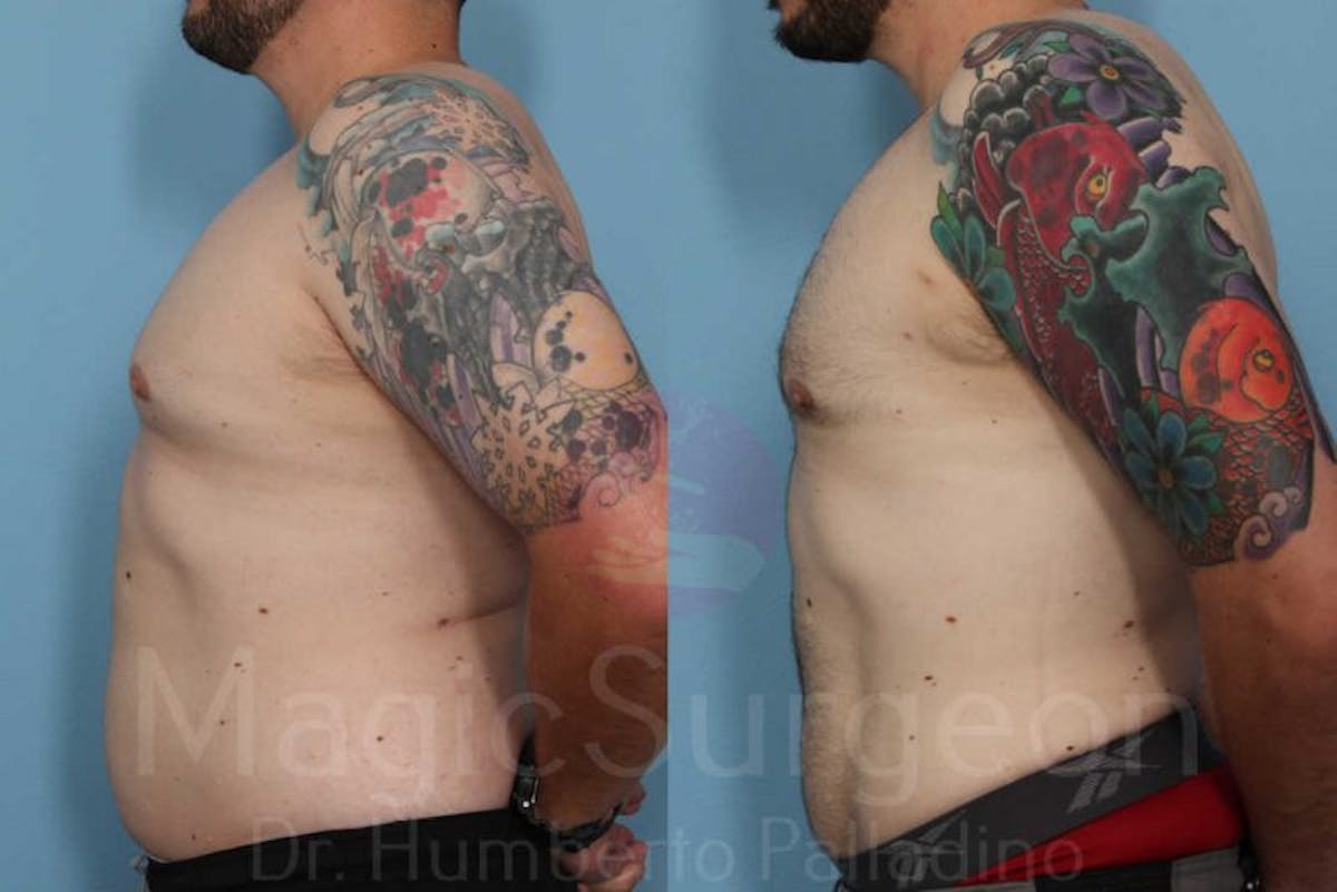 Liposuction Before & After Gallery - Patient 133182328 - Image 3