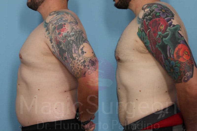 Liposuction Before & After Gallery - Patient 133182328 - Image 3