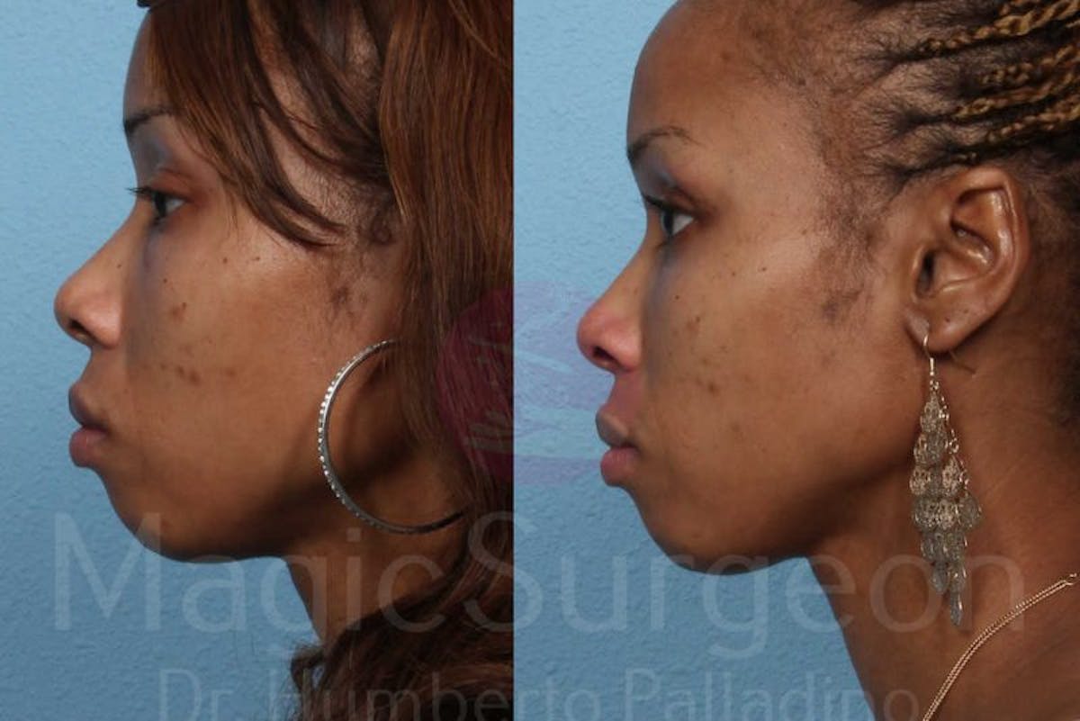 Blepharoplasty Before & After Gallery - Patient 133182326 - Image 3