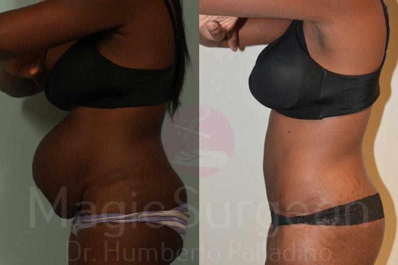 Tummy Tuck Before & After Gallery - Patient 133182327 - Image 3