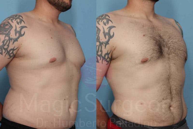 Liposuction Before & After Gallery - Patient 133182328 - Image 4