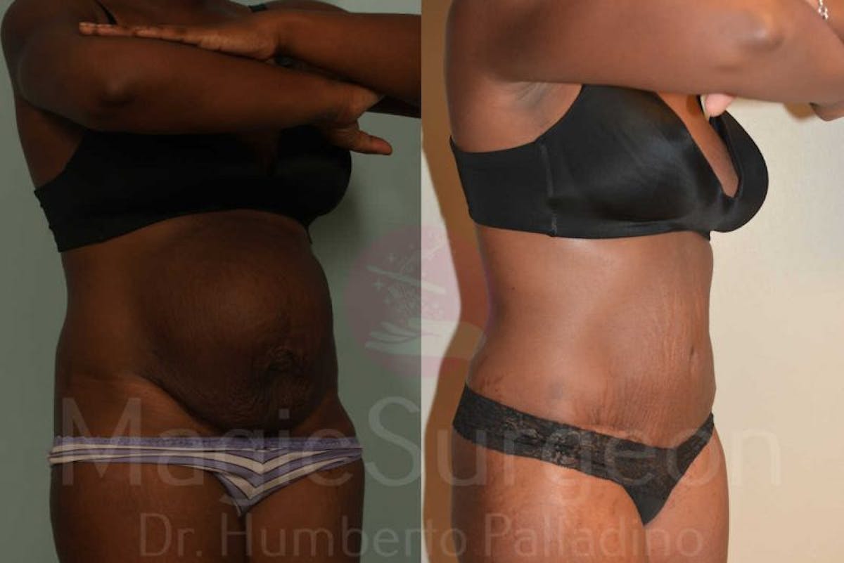 Tummy Tuck Before & After Gallery - Patient 133182327 - Image 4