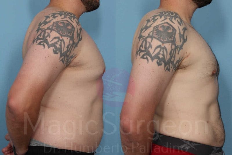 Liposuction Before & After Gallery - Patient 133182328 - Image 5