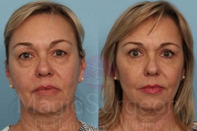 Blepharoplasty Before & After Gallery - Patient 133182331 - Image 1
