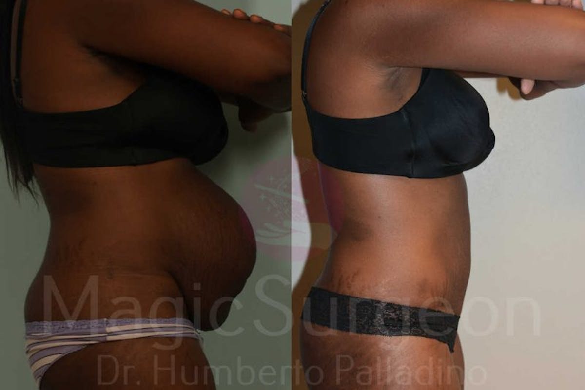 Tummy Tuck Before & After Gallery - Patient 133182327 - Image 5