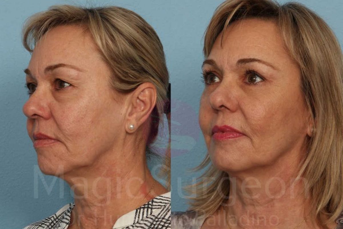 Blepharoplasty Before & After Gallery - Patient 133182331 - Image 2