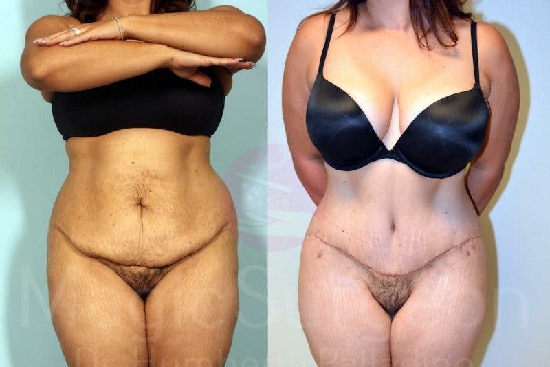 Tummy Tuck Before & After Gallery - Patient 133182332 - Image 1