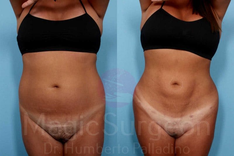 Liposuction Before & After Gallery - Patient 133182333 - Image 1