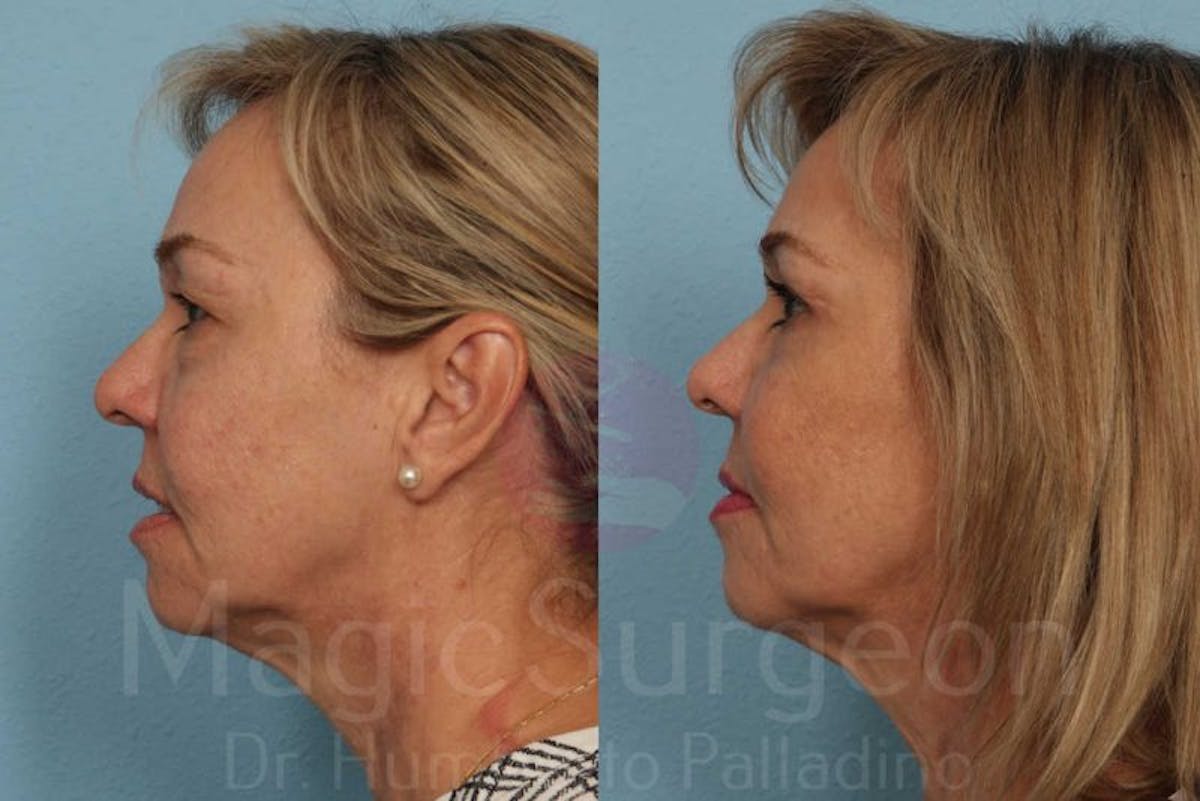 Blepharoplasty Before & After Gallery - Patient 133182331 - Image 3