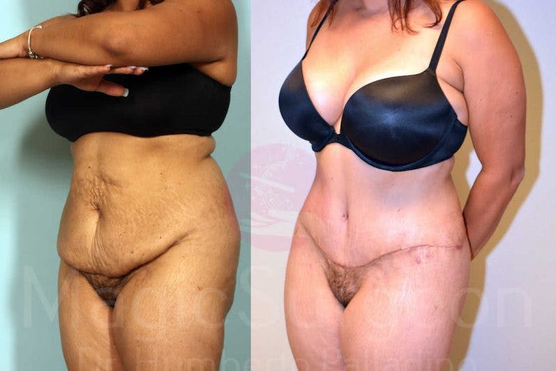 Tummy Tuck Before & After Gallery - Patient 133182332 - Image 2