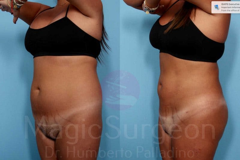 Liposuction Before & After Gallery - Patient 133182333 - Image 2