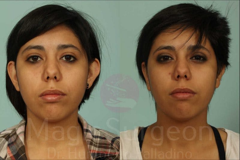 Buccal Fat Pad Removal Before & After Gallery - Patient 133182329 - Image 1