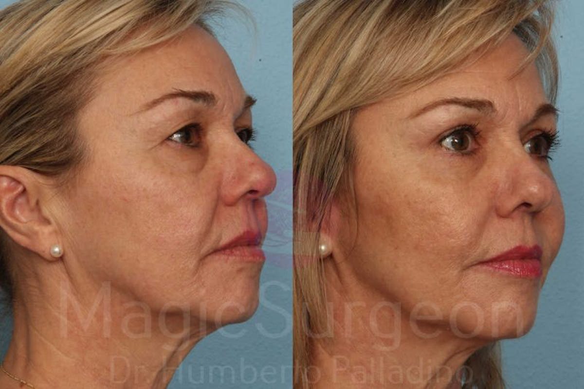Blepharoplasty Before & After Gallery - Patient 133182331 - Image 4