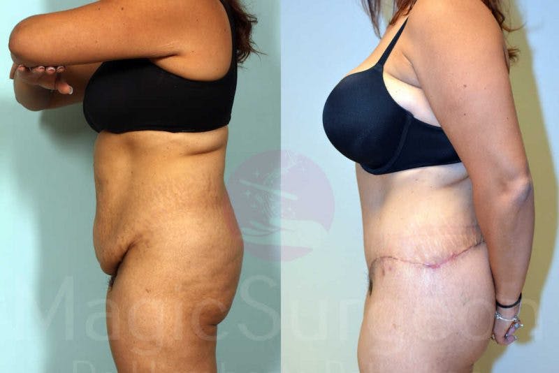 Tummy Tuck Before & After Gallery - Patient 133182332 - Image 3