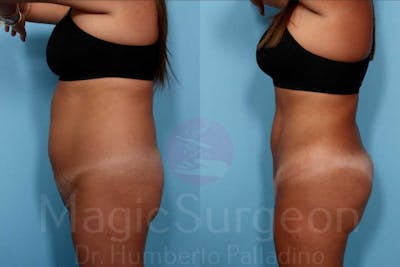 Liposuction Before & After Gallery - Patient 133182333 - Image 1