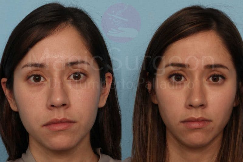 Buccal Fat Pad Removal Before & After Gallery - Patient 133182330 - Image 1