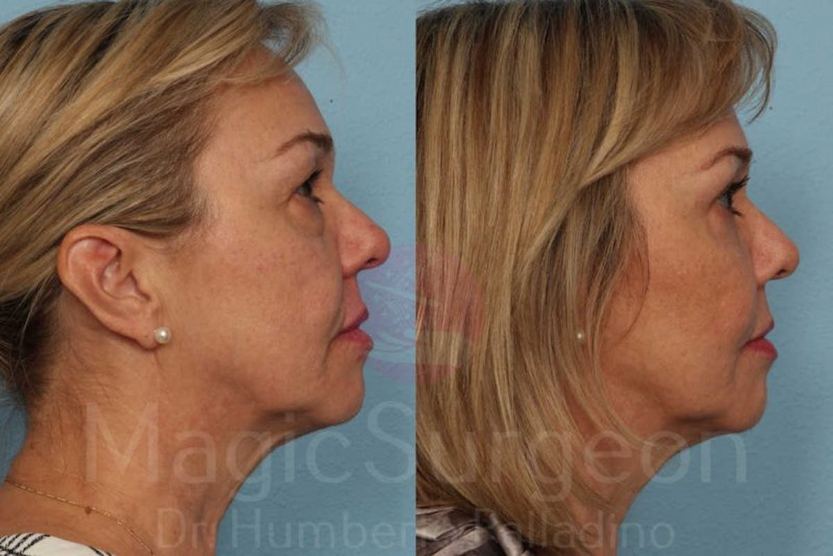 Blepharoplasty Before & After Gallery - Patient 133182331 - Image 5
