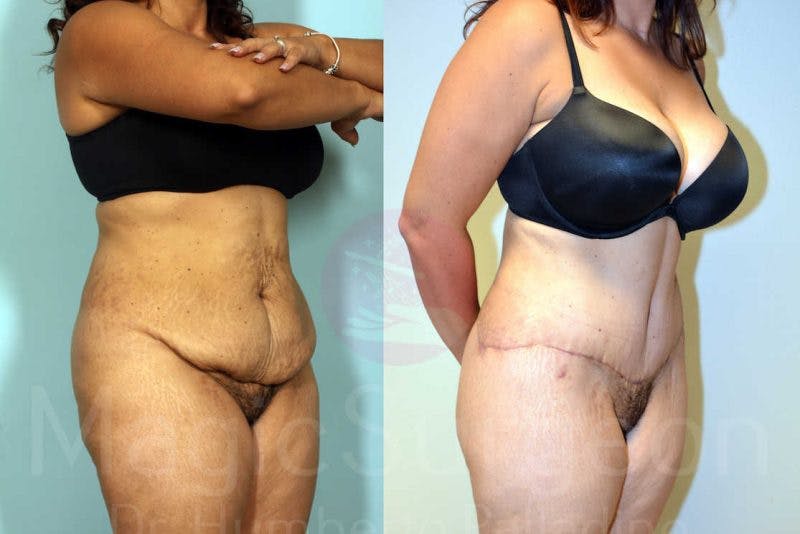 Tummy Tuck Before & After Gallery - Patient 133182332 - Image 4