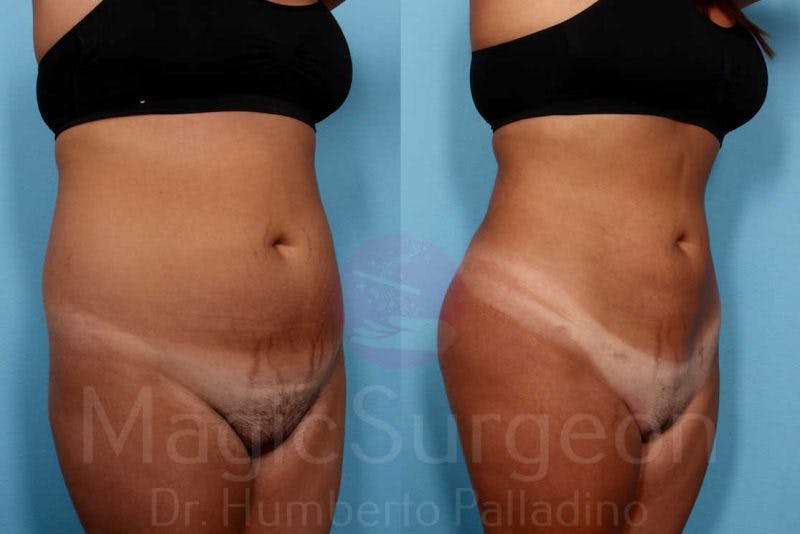 Liposuction Before & After Gallery - Patient 133182333 - Image 4