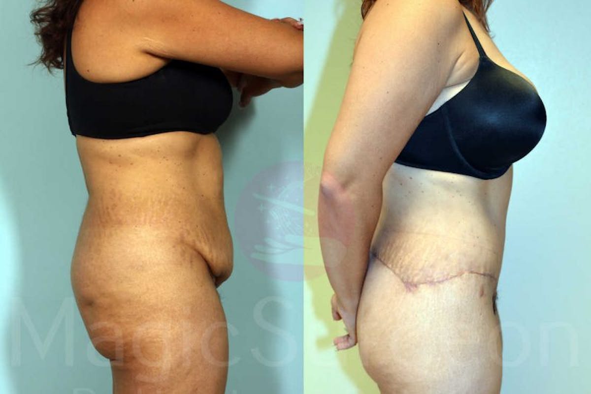 Tummy Tuck Before & After Gallery - Patient 133182332 - Image 5