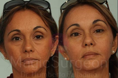 Blepharoplasty Before & After Gallery - Patient 133182334 - Image 1