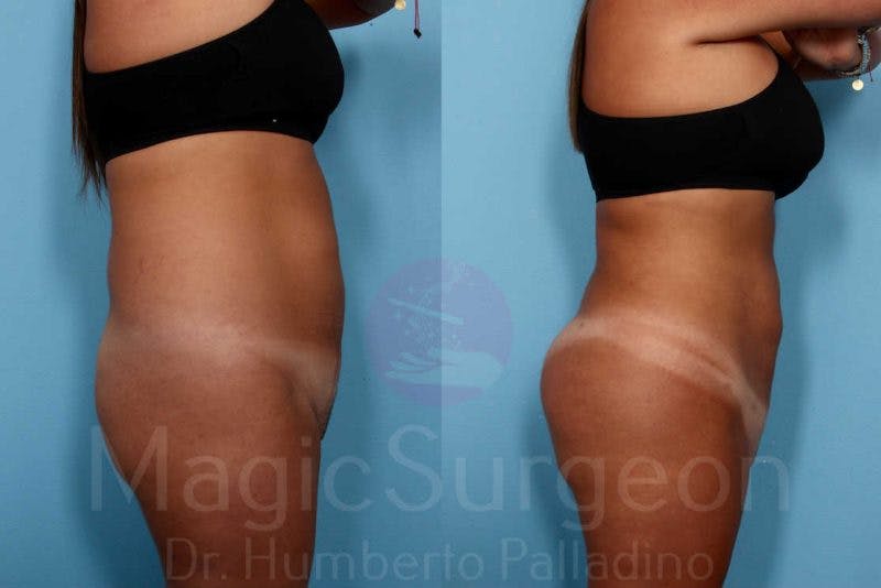 Liposuction Before & After Gallery - Patient 133182333 - Image 5