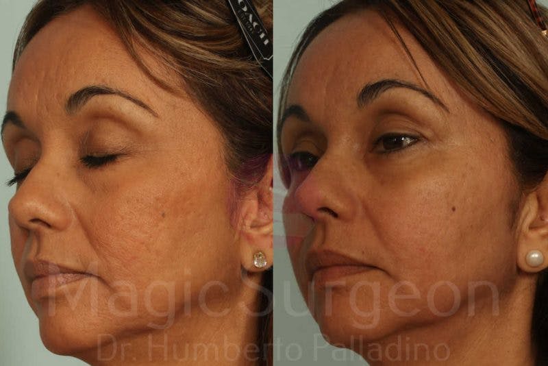 Blepharoplasty Before & After Gallery - Patient 133182334 - Image 2