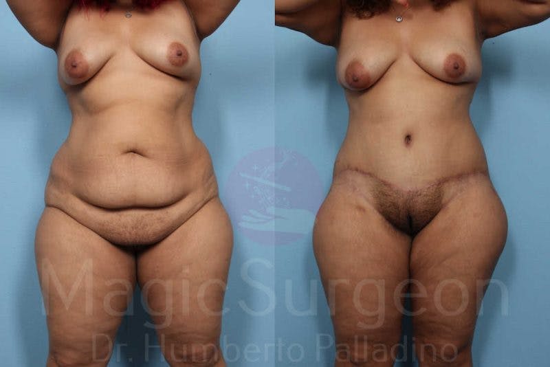 Tummy Tuck Before & After Gallery - Patient 133182339 - Image 1
