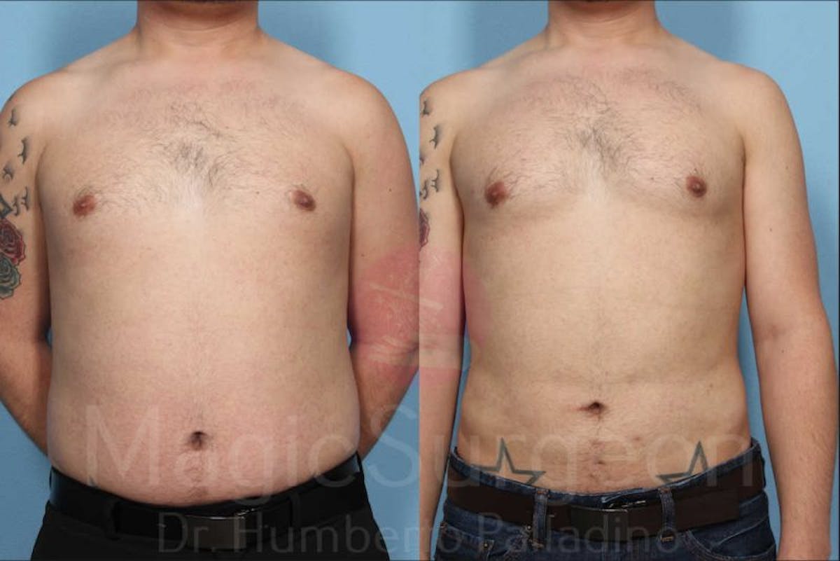Liposuction Before & After Gallery - Patient 133182335 - Image 1