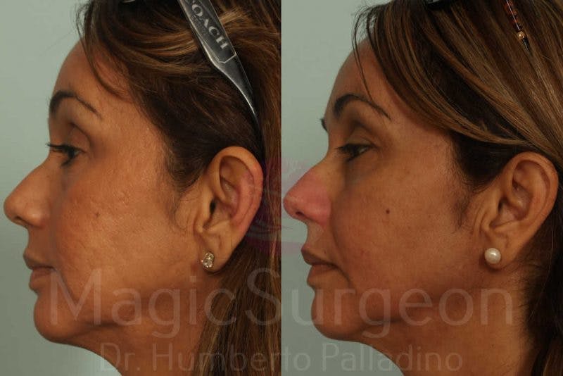 Blepharoplasty Before & After Gallery - Patient 133182334 - Image 3