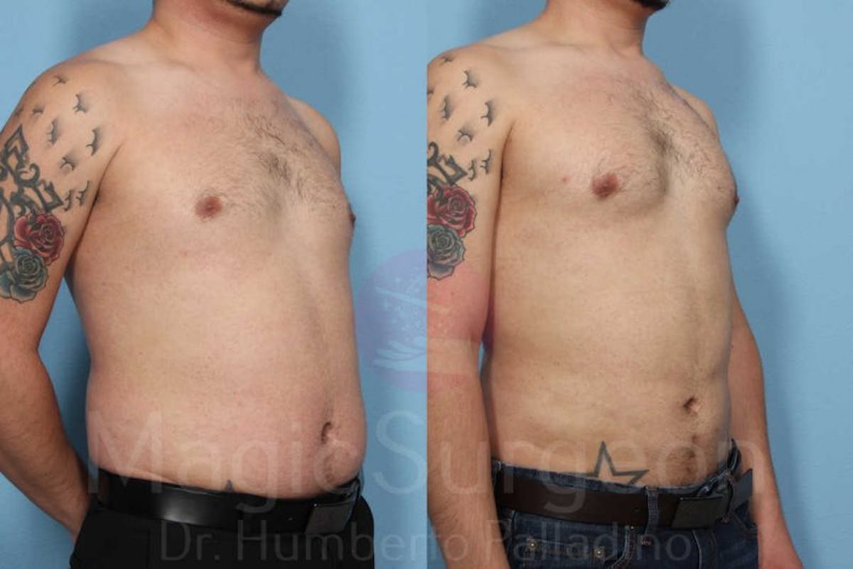 Liposuction Before & After Gallery - Patient 133182335 - Image 2