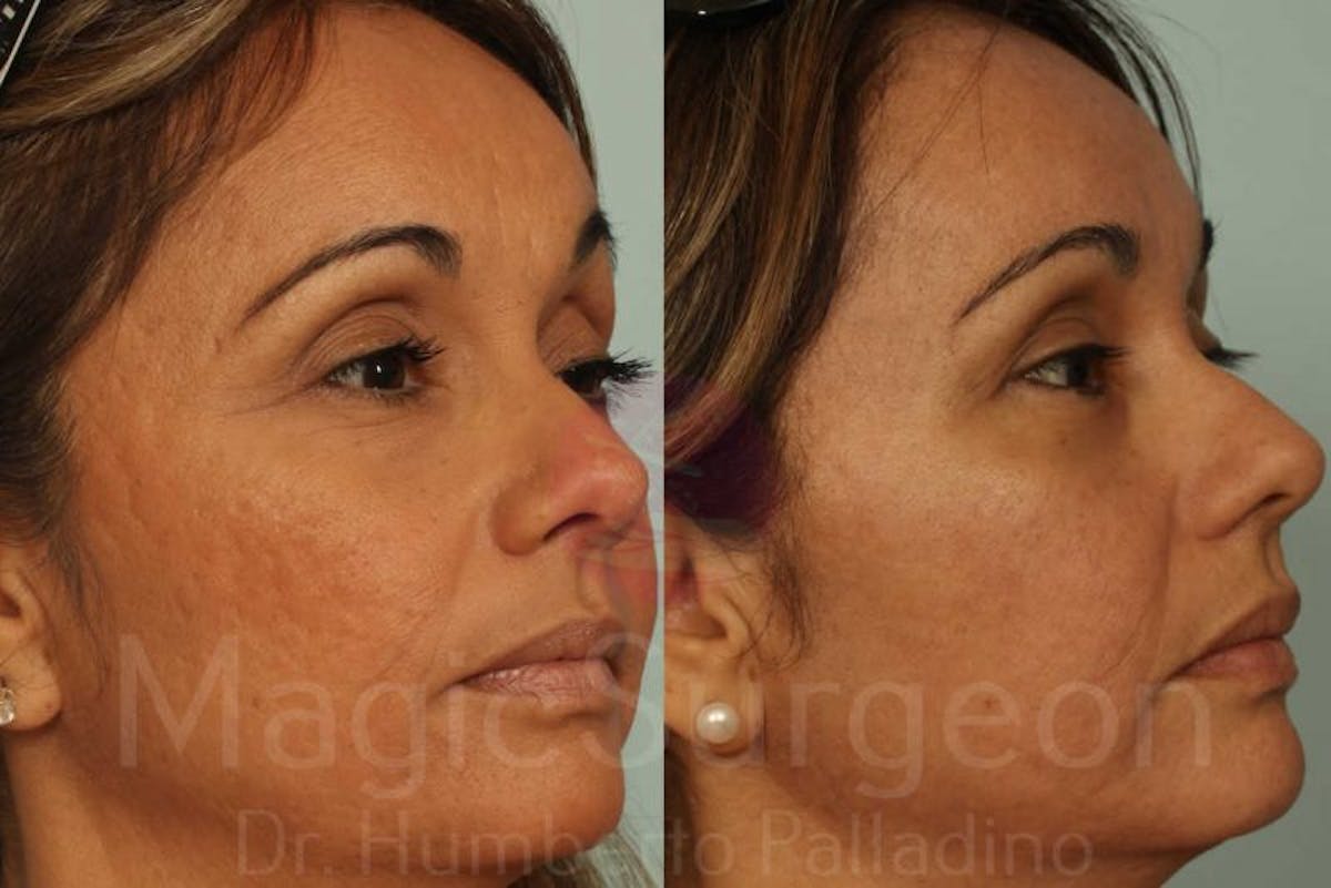 Blepharoplasty Before & After Gallery - Patient 133182334 - Image 4