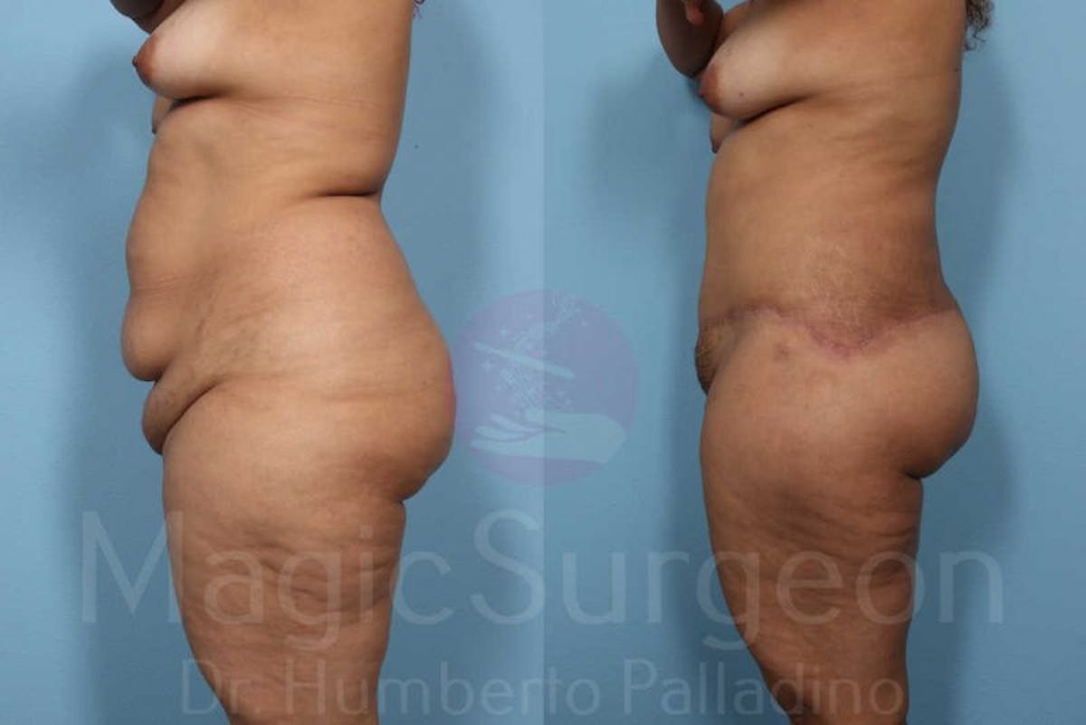Tummy Tuck Before & After Gallery - Patient 133182339 - Image 3